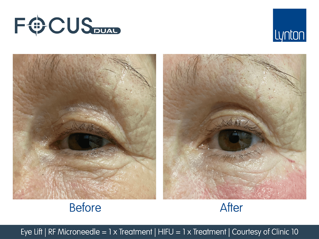 Focus  Dual HIFU FT Microneedling Before and After- Bromley