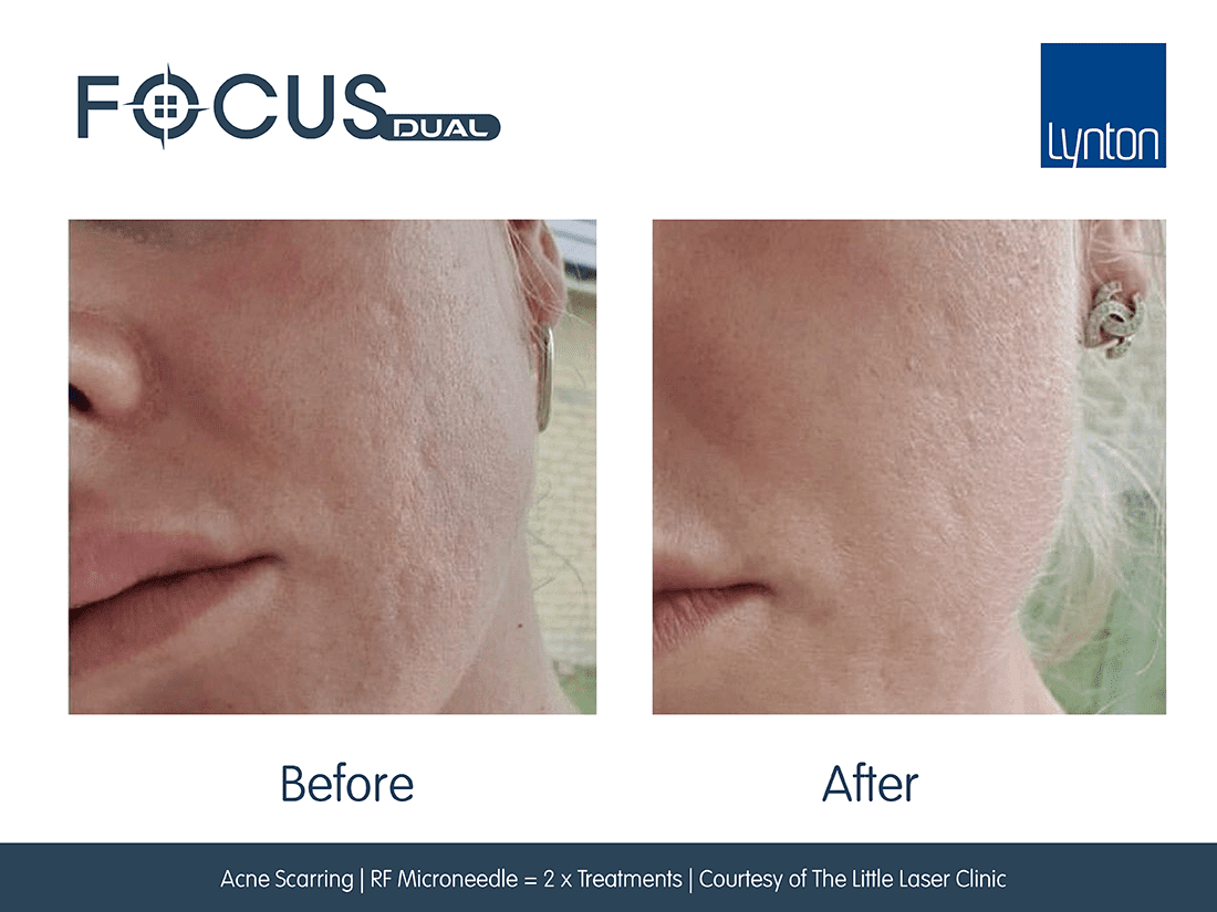 Focus  Dual HIFU FT Microneedling Before and After- Bromley