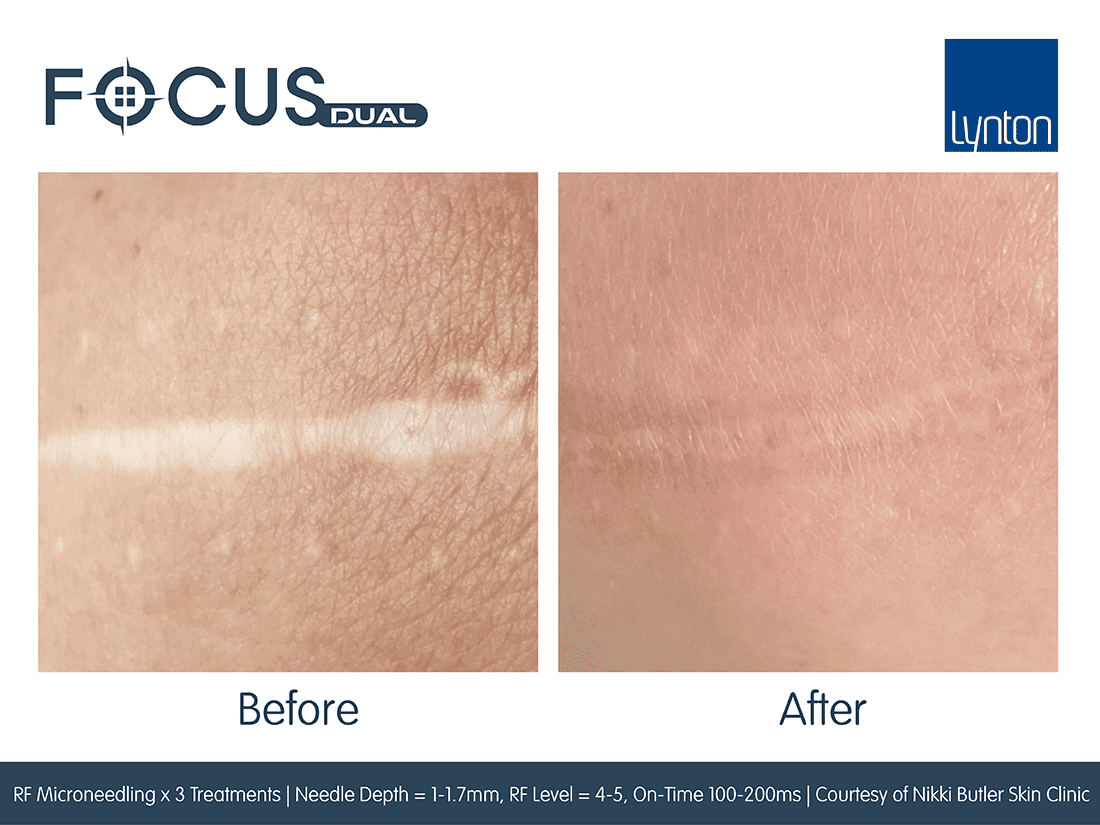 Focus  Dual HIFU FT Microneedling Before and After- Bromley