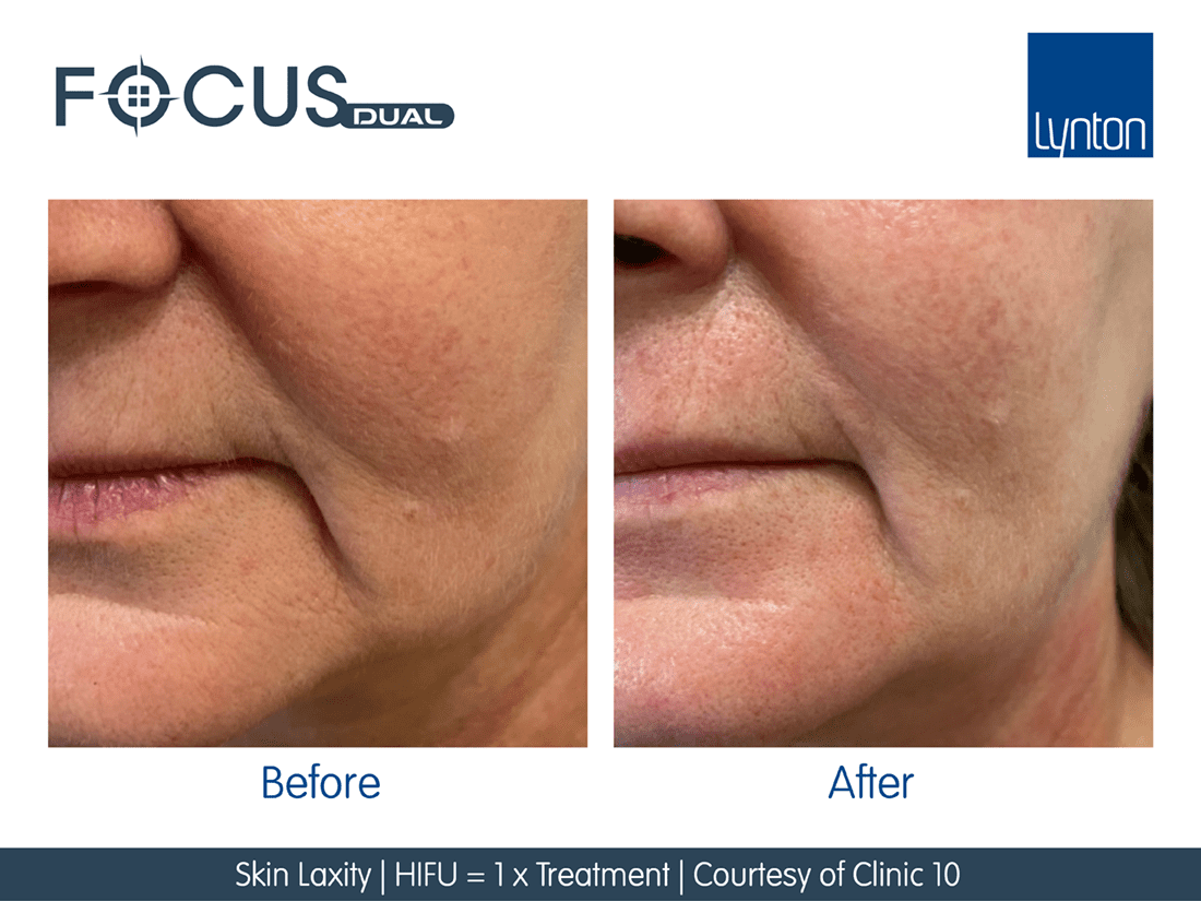 Focus  Dual HIFU FT Microneedling Before and After- Bromley