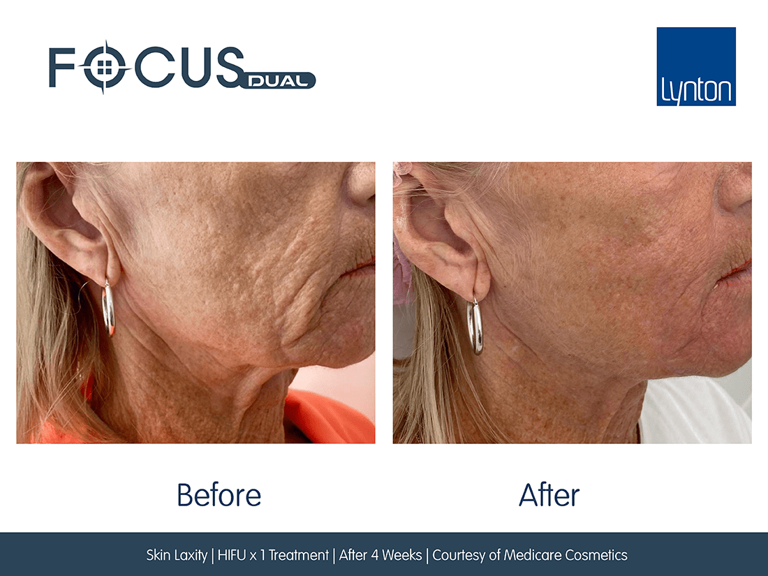 Focus  Dual HIFU FT Microneedling Before and After- Bromley