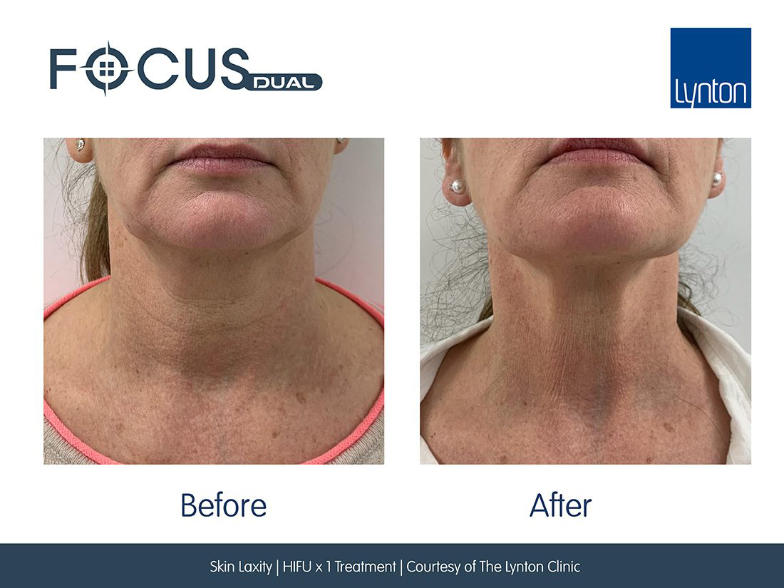 Focus  Dual HIFU FT Microneedling Before and After- Bromley