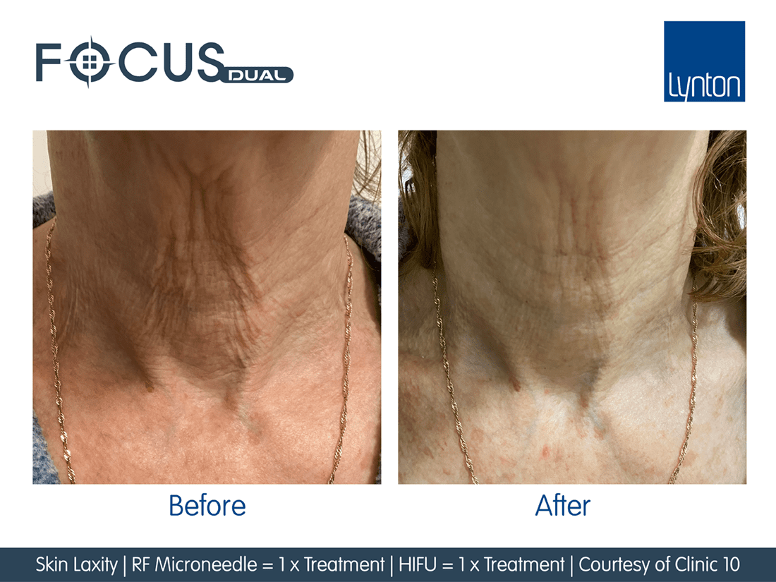 Focus  Dual HIFU FT Microneedling Before and After- Bromley