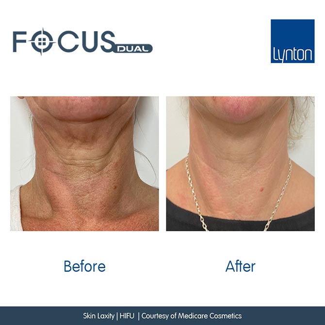 Focus  Dual HIFU FT Microneedling Before and After- Bromley