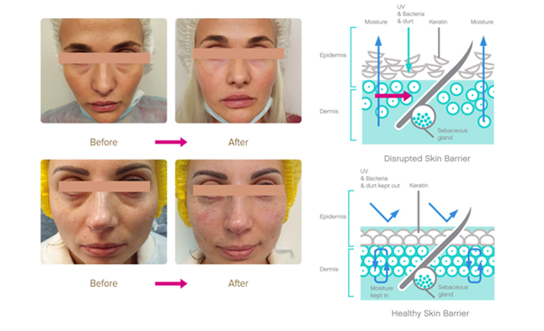 Lumi Eyes - Before and After