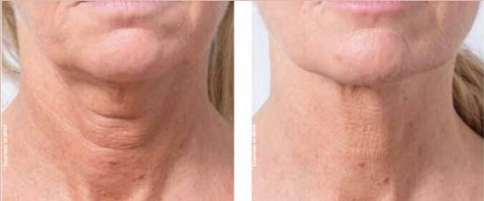 Profhilo  - Before & After- Julie Jacobs-French