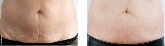 Profhilo  - Before & After- Julie Jacobs-French
